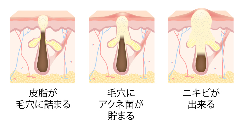 ニキビ治療｜静岡中央クリニック・東京中央クリニック【公式】｜美容外科・美容皮膚科・形成外科