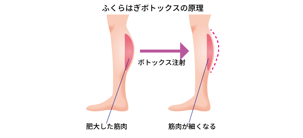 ふくらはぎ筋肉 注入治療 公式 静岡中央クリニック 医療レーザー脱毛から外科手術まで幅広く対応