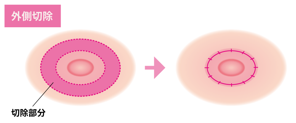 乳輪縮小の治療方法