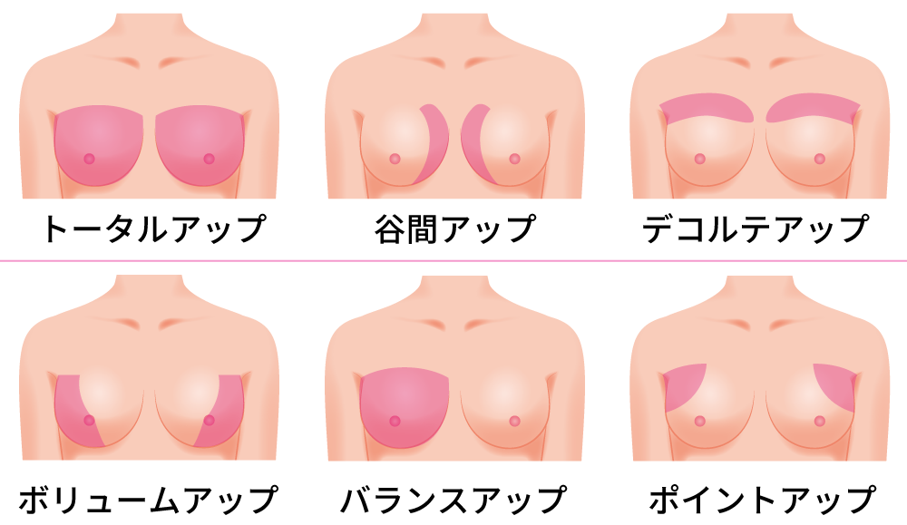 豊胸術（ヒアルロン酸）について