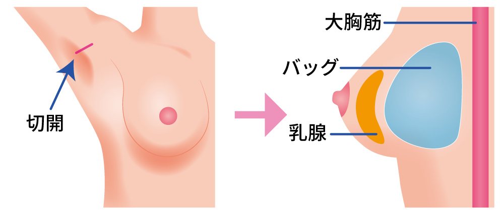 豊胸術（シリコンバッグ挿入）とは