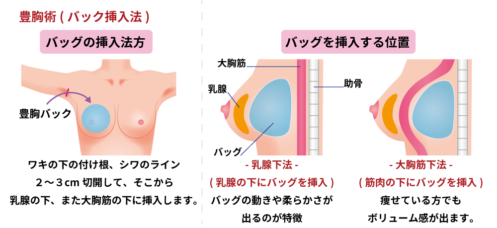 シリコンバッグ挿入の治療方法