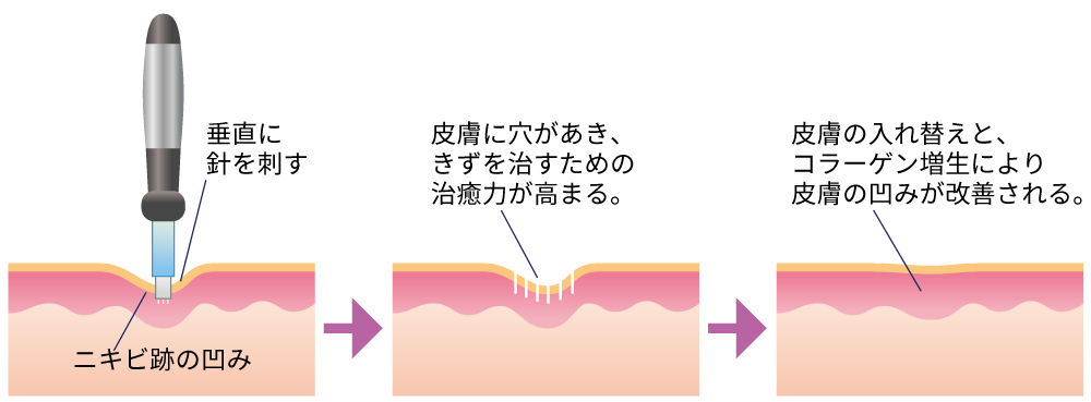 跡 ダーマペン ニキビ