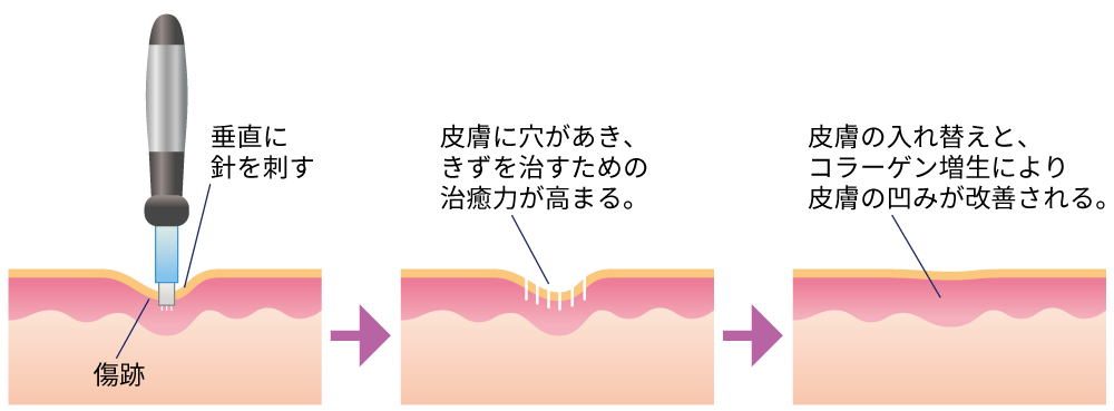 ダーマペンとは