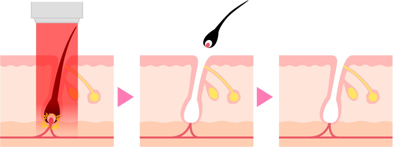 医療レーザー脱毛のメカニズム