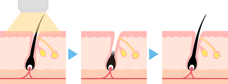 エステ脱毛のメカニズム