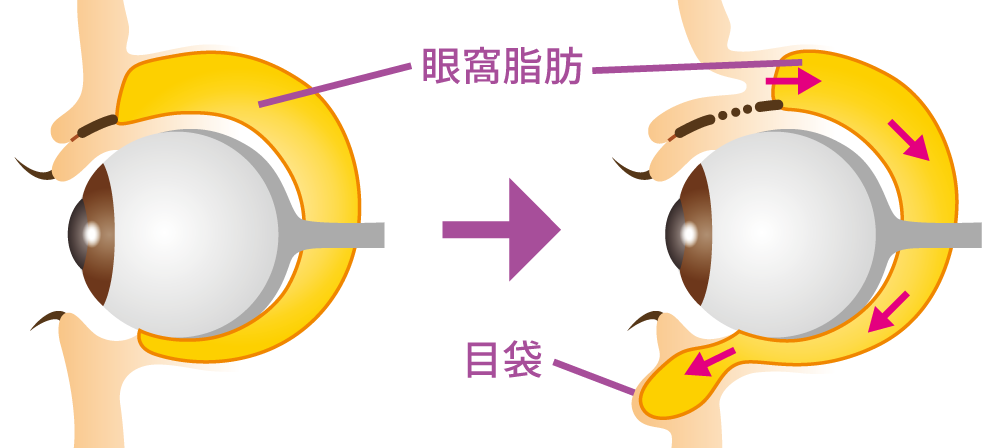 脂肪除去術の治療方法