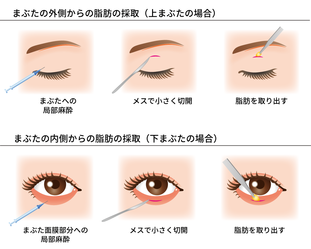 脂肪除去術の治療方法