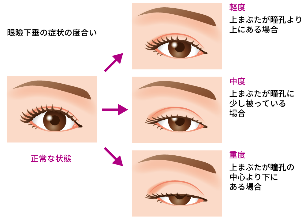 一重 の まま 眼瞼 下垂