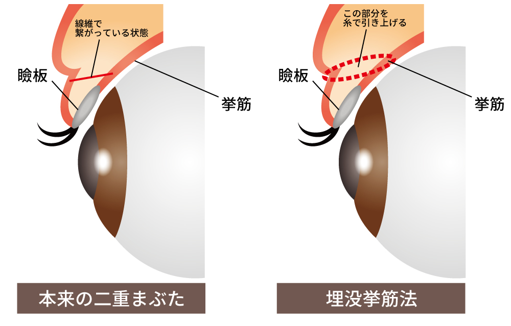 本来の二重まぶたについて