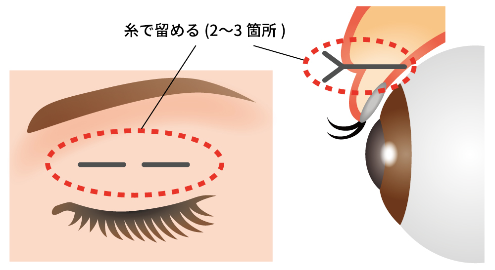 ナチュラルeyes挙筋埋没法の治療方法