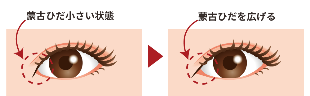 目頭切開術の治療方法