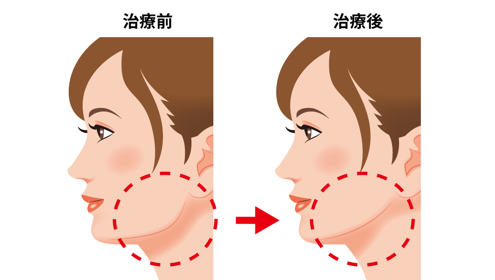 頬の骨削り