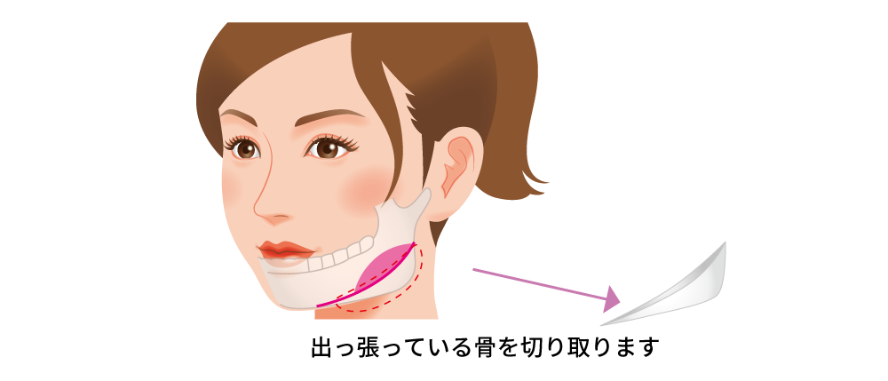 エラ骨削りについて