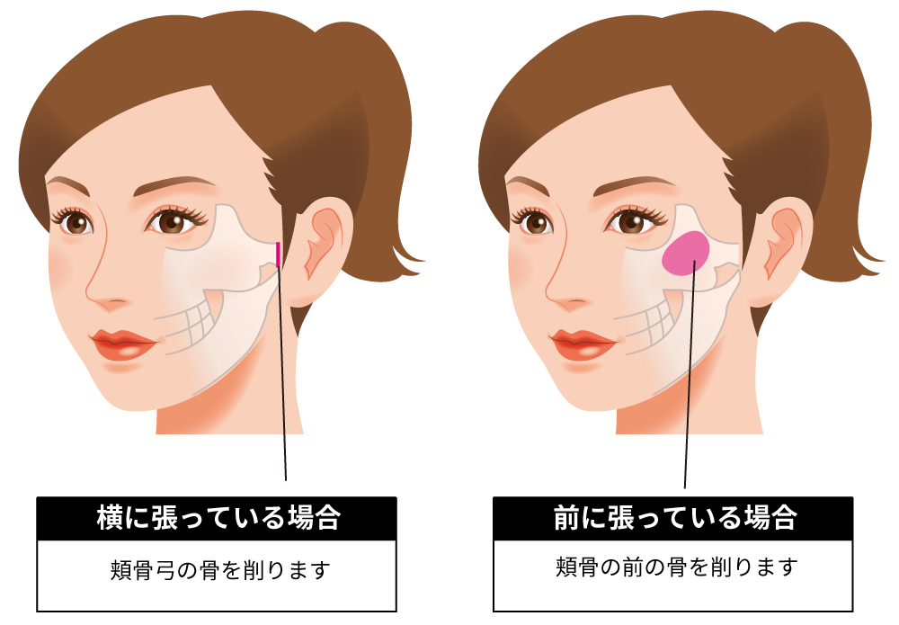 頬骨 が 出 て いる