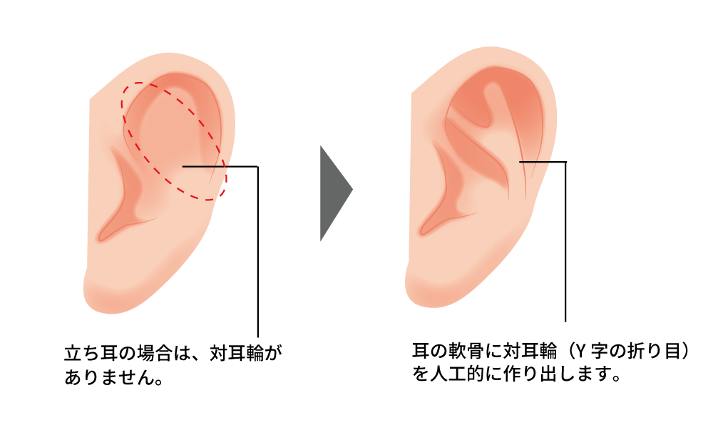 立ち耳の治療方法