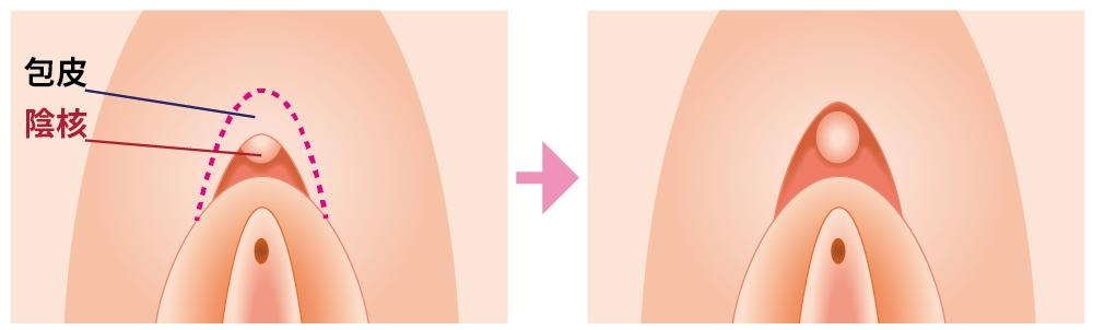 クリトリス包茎とは