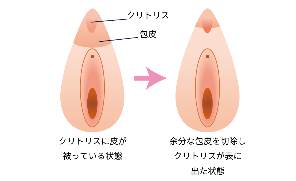 クリトリス包茎手術
							