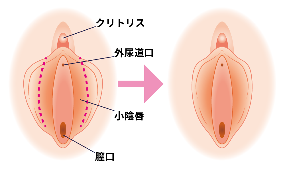 小陰唇縮小術とは