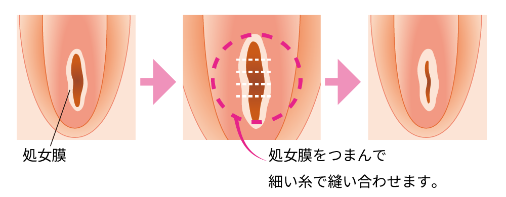 処女膜とは