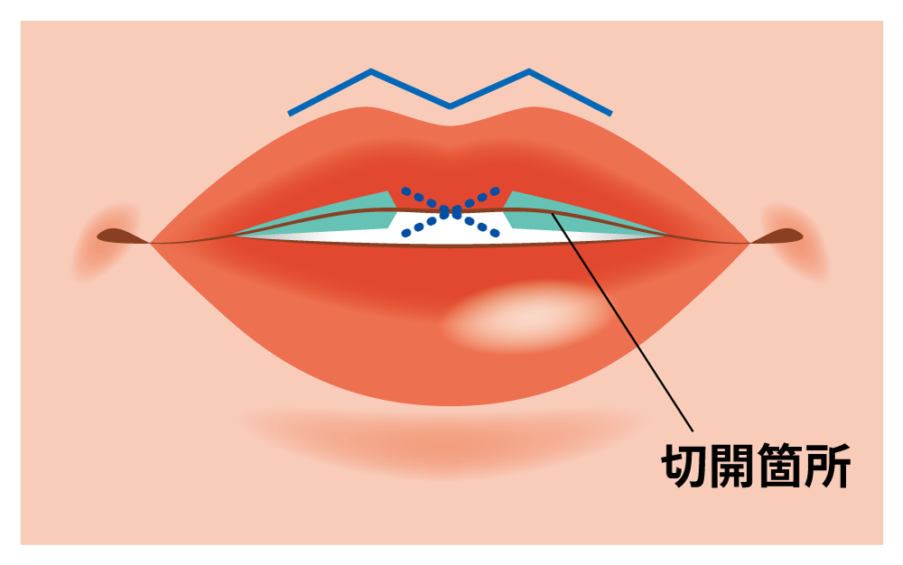 M字リップ