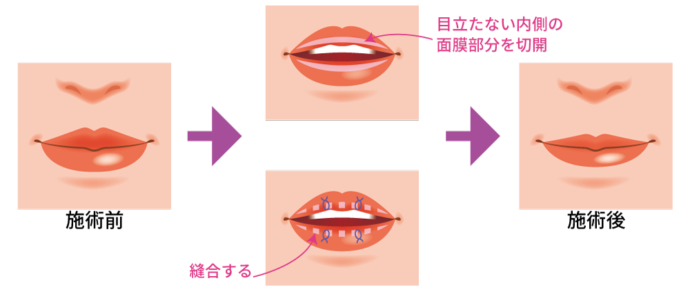 改善 たらこ 唇 たらこ唇の治し方！原因や改善法まとめ【整形するのも手】