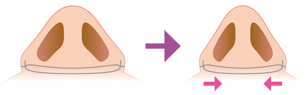 小鼻縮小（埋没式）について