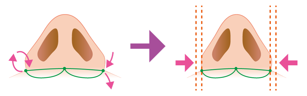 小鼻縮小（埋没式）の治療方法