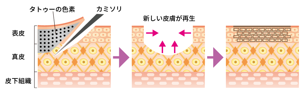 脱脂の治療方法