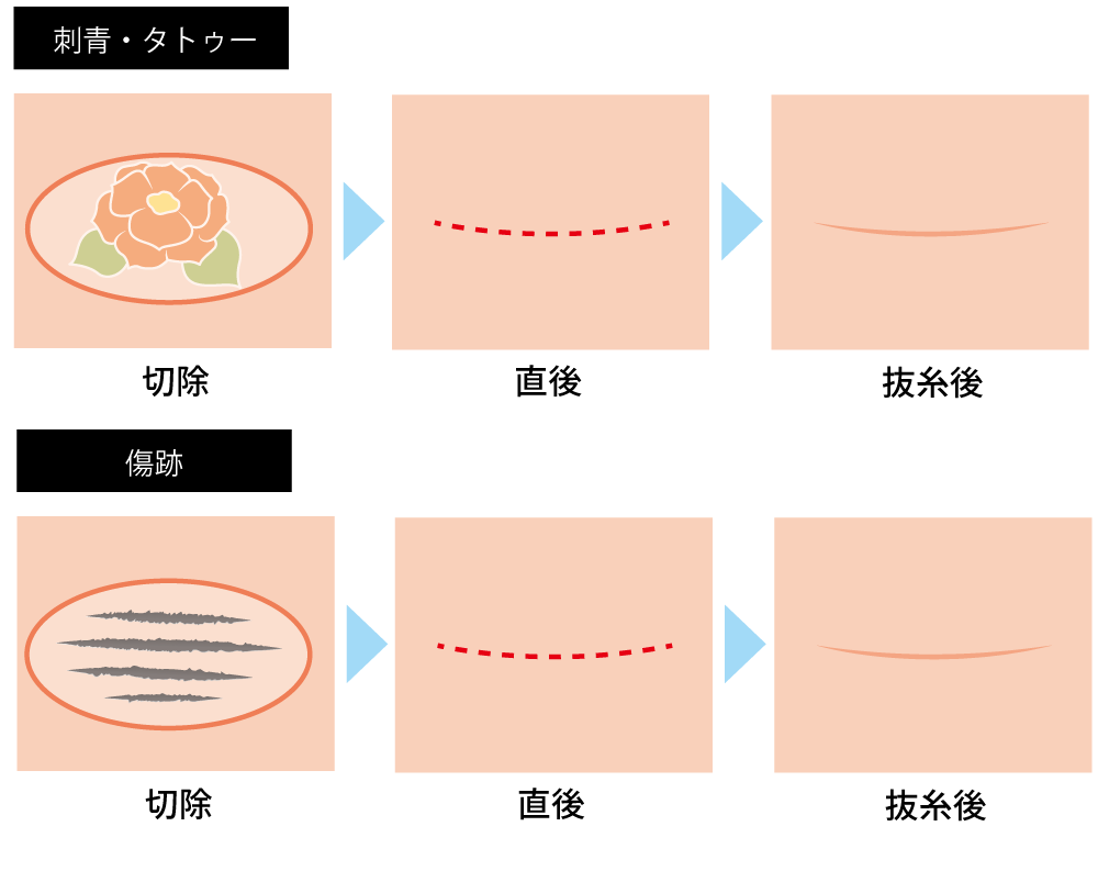 脱脂の治療方法