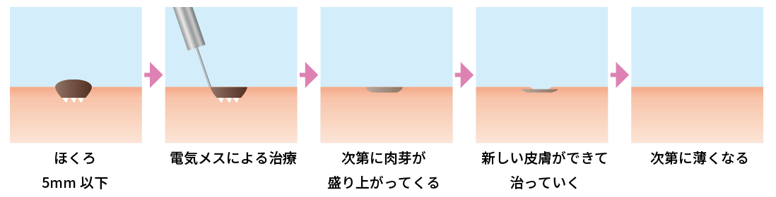 脱脂の治療方法