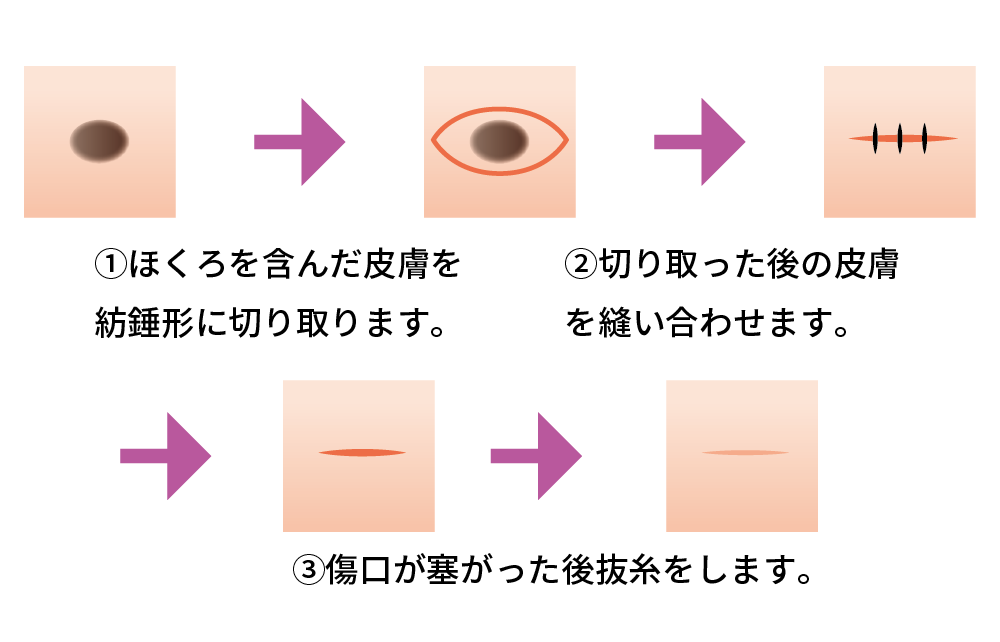 脱脂の治療方法