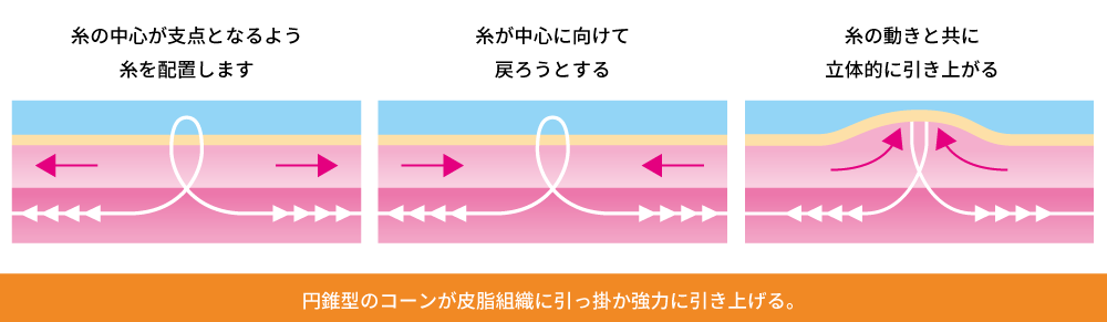 シルエットソフトの治療
							