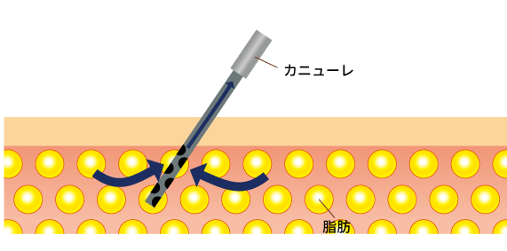 脂肪吸引の治療方法