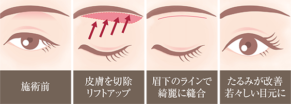 ブローリフト図